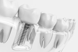 Dental Lavelle Implant Dentistry