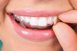 Dental Lavelle Invisalign Clear Aligners