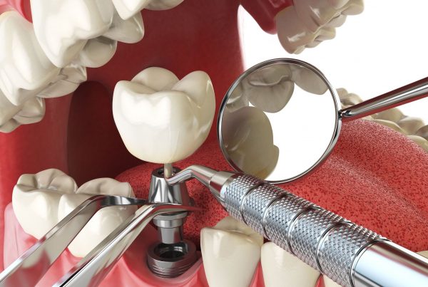 Dental Implant Treatment In Bangalore
