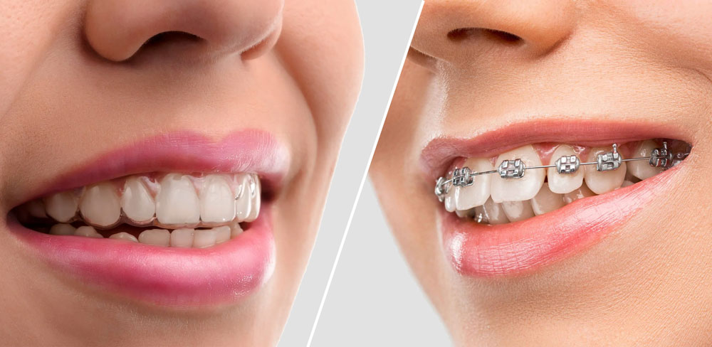 Advantages of Invisalign Over Traditional Braces