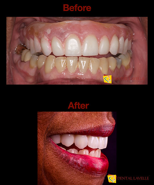Dental Implants Treatment Before vs After
