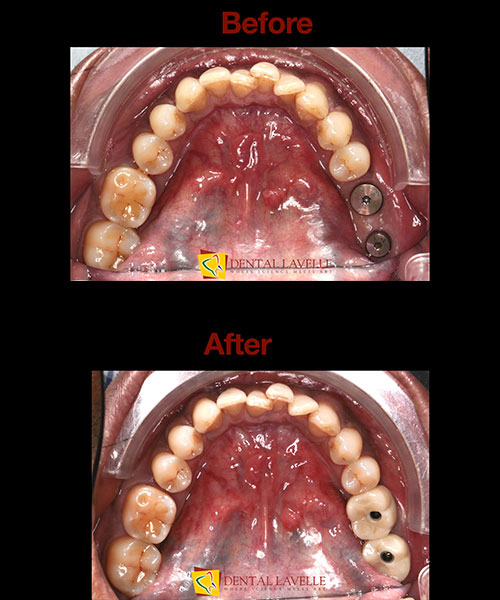 Dental Implants Treatment Before vs After