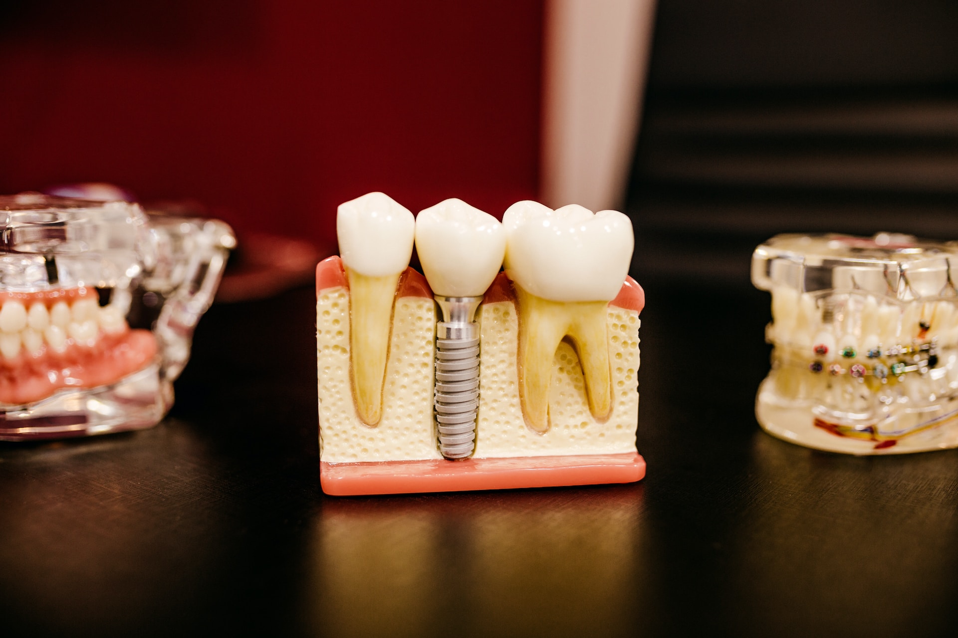 Dental Lavelle Dental Implants Treatment In Bangalore