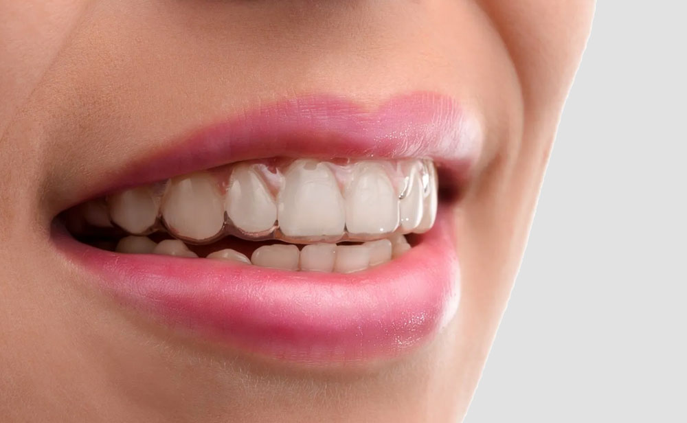 Dental Lavelle Invisalign Treatment -How Much Do These Clear Braces Cost