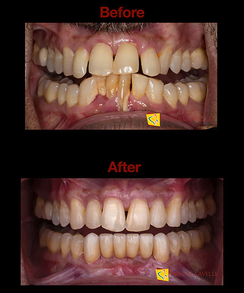 Invisalign Treatment Before vs After