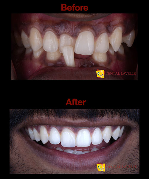 Invisalign Treatment Before vs After
