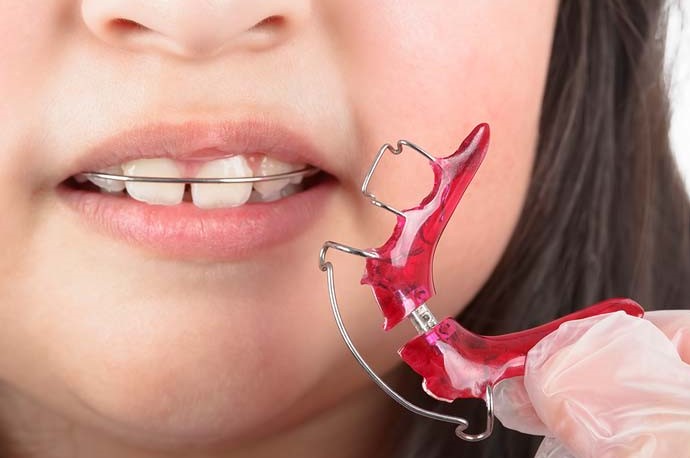 Childrens Orthodontic Treatment Teeth Retainer
