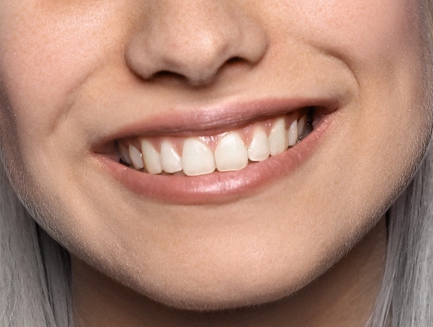 Smile Makeover Treatment At Dental Lavelle